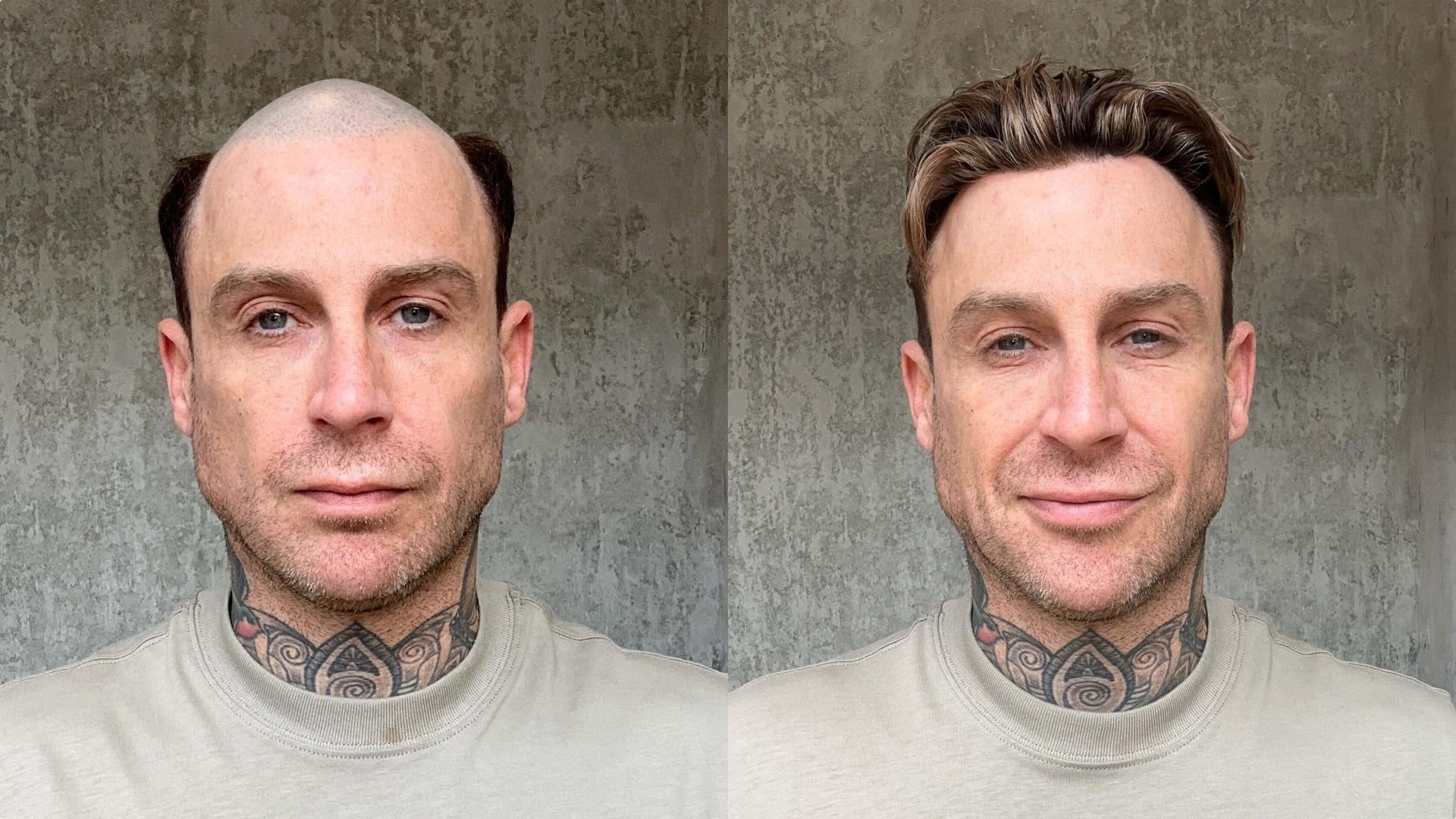 Hybrid Hair System - Multi-functional Design - Enhanced Airflow - Low Maintenance - (Recommended)