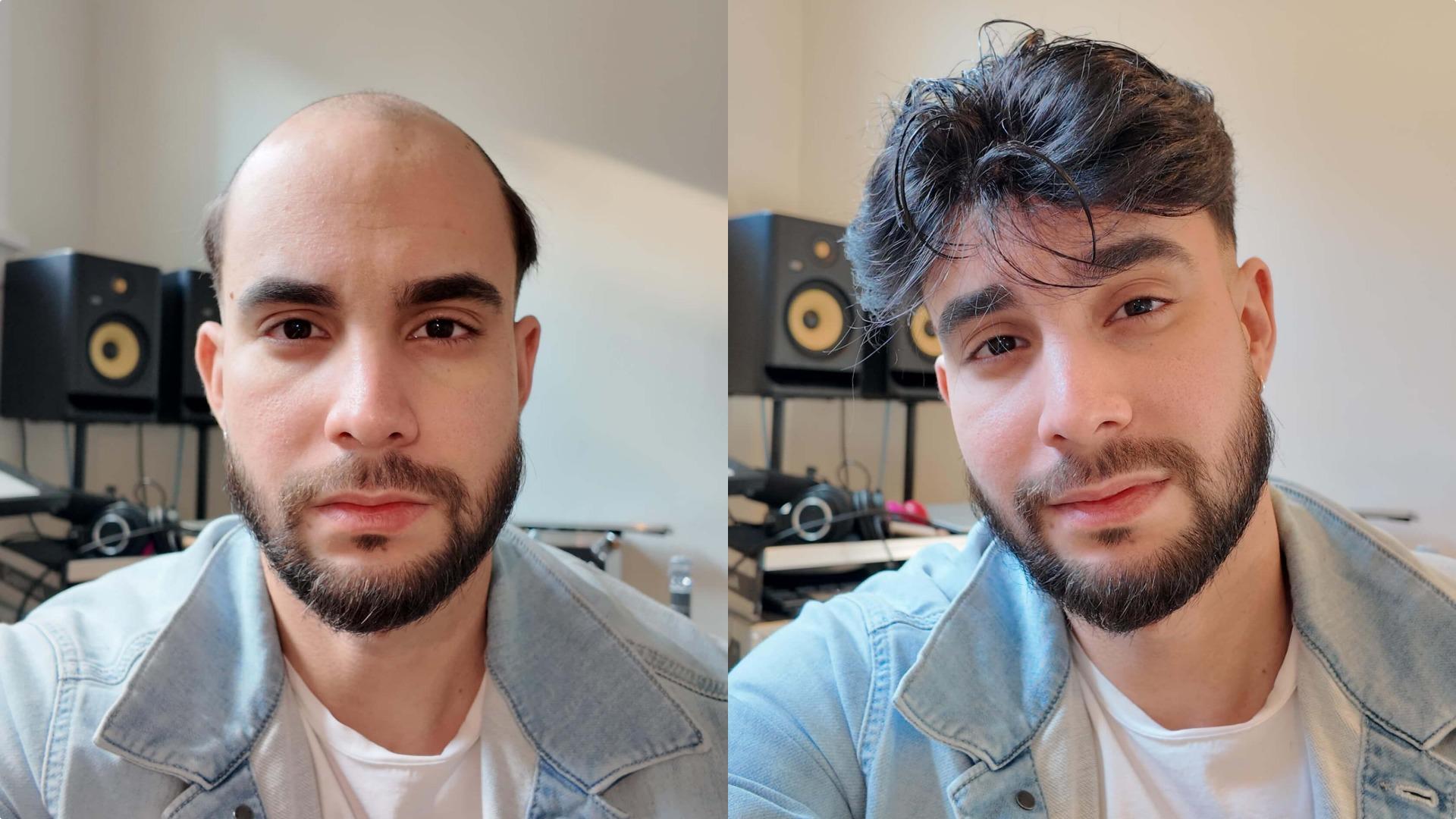 Mono Hair System - Industry-first design - Thicker density - Superior Durability - Extended Lifespan