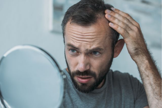 Hair loss from testosterone