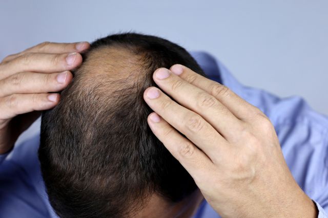 Hair loss from testosterone