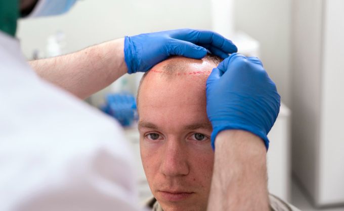 blood tests for hair loss in females