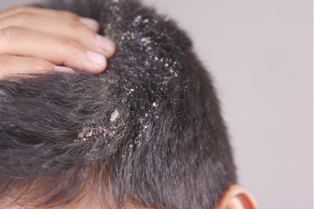 can dandruff cause hair thinning