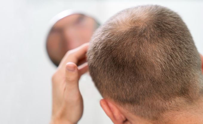 immunotherapy alopecia areata