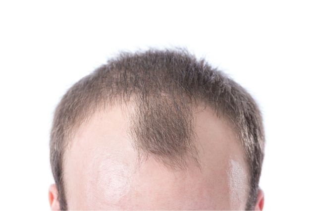 m shaped hairline