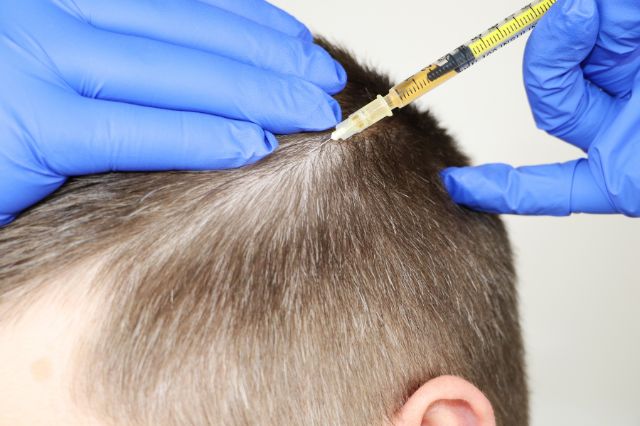 mesotherapy for hair loss