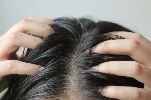 oily scalp and hair loss