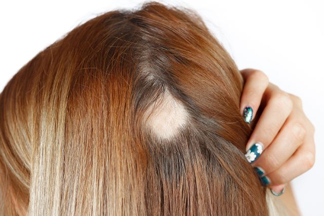 triangular alopecia