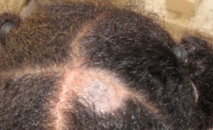 hair loss types male