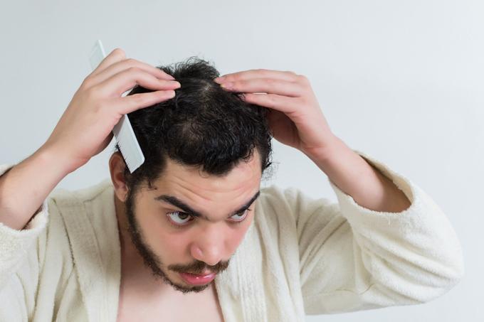 hair loss in younger men 