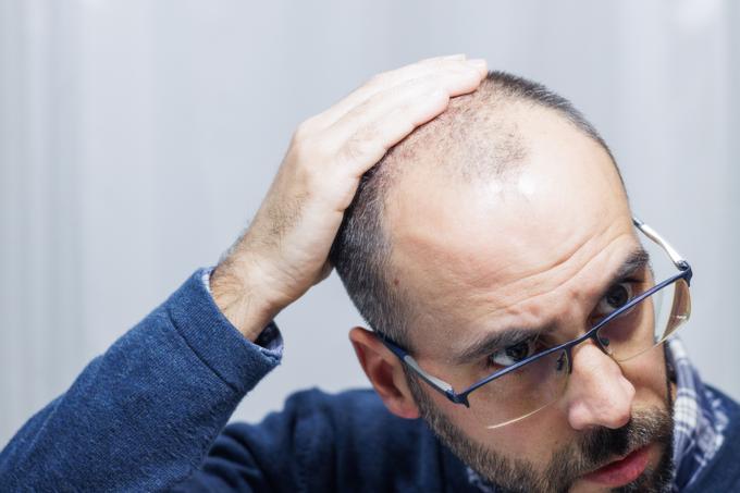 receding hairline styles 