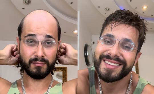 Before and after wearing a Hair system